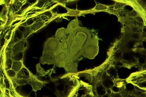 Benign breast disease calcifications