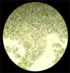 Cancerous lymphoma cells