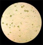 Cells after treatment, virtually all cancer is gone