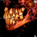 Images from the recent CT scans of the mummy show that the child still had some of its baby teeth, with adult teeth coming in. (Photo by David Hunt, Smithsonian Institution)