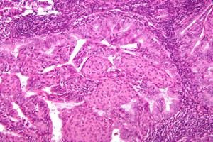 The Hand2 finding could help researchers understand disorders in which the growth of the uterine lining surges out of control, such as endometrial cancer. Above shows a high magnification micrograph of endometrioid endometrial adenocarcinoma, the most common form of endometrial cancer.