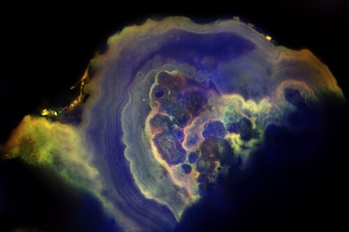 A precursor to invasive breast cancer