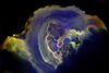 Ductal carcinoma in situ, a precursor to invasive breast cancer.